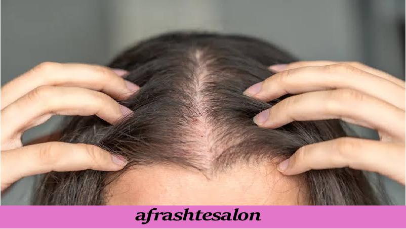 ریزش مو فصلی چیست
