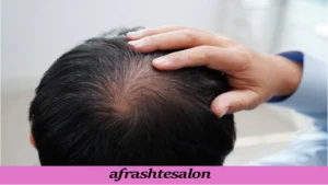 ریزش مو فصلی چیست